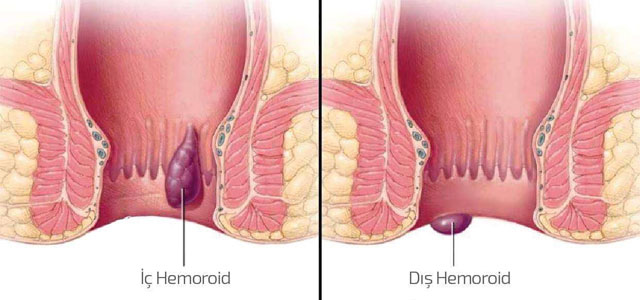 iç ve dış hemoroid